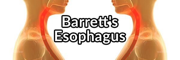 barrett-s-esophagus-what-is-it-and-what-can-be-done-to-hopefully